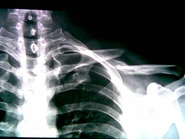 collarbone.jpg